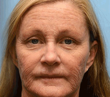 👨‍⚕️Made and shipped from Australia💫 Vita-A Retinol Shot Wrinkle-Lift Tightening cream - Last Day Promotion 70% OFF